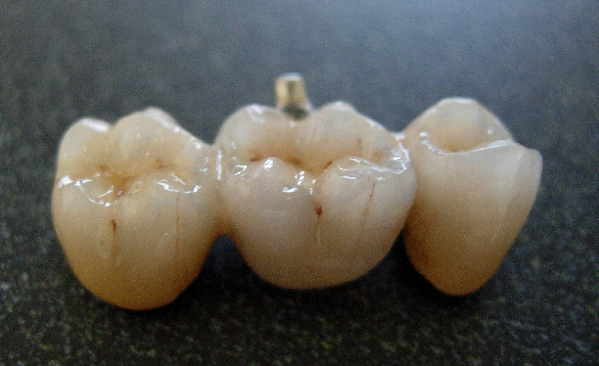 Bridge_from_dental_porcelain | Atlanta Based Systems